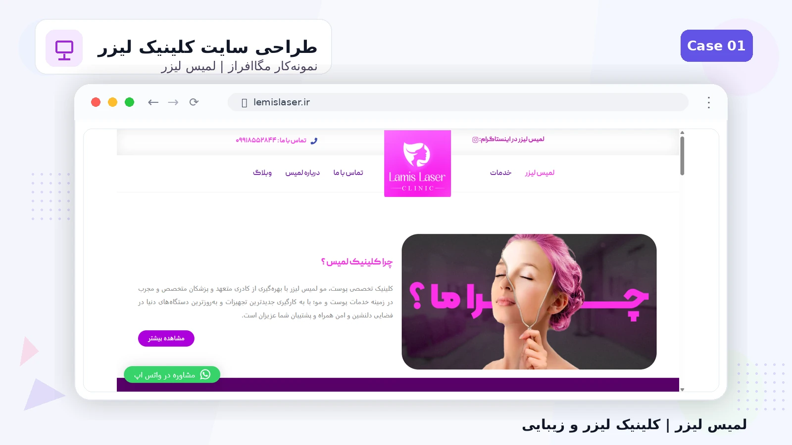 لمیس لیزر - تصویر 1