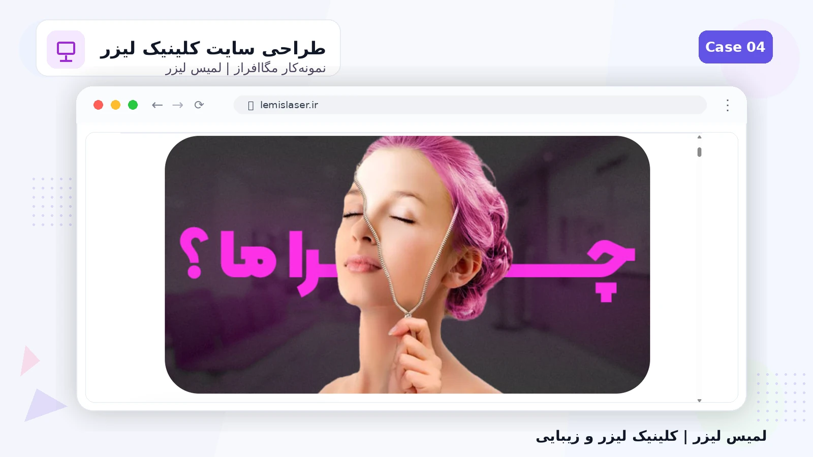 لمیس لیزر - تصویر 4